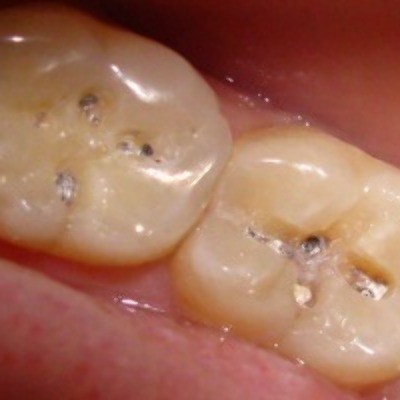 Лечение парадонтоза в стоматологической клинике в Котельниках