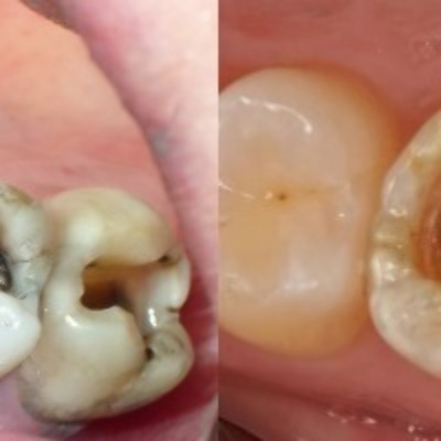 Лечение зубов в стоматологической клинике в Котельниках